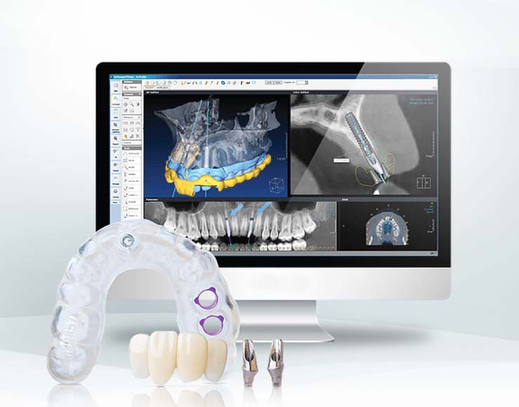 Implant Device Computer Implantologia computer guidata: una tecnica innovativa